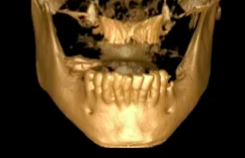 Immediate Loading - Part 2: All-on-4 Expanded Applications