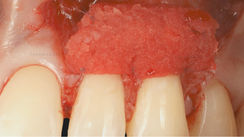 Minimally Invasive Treatment of Gingival Recessions