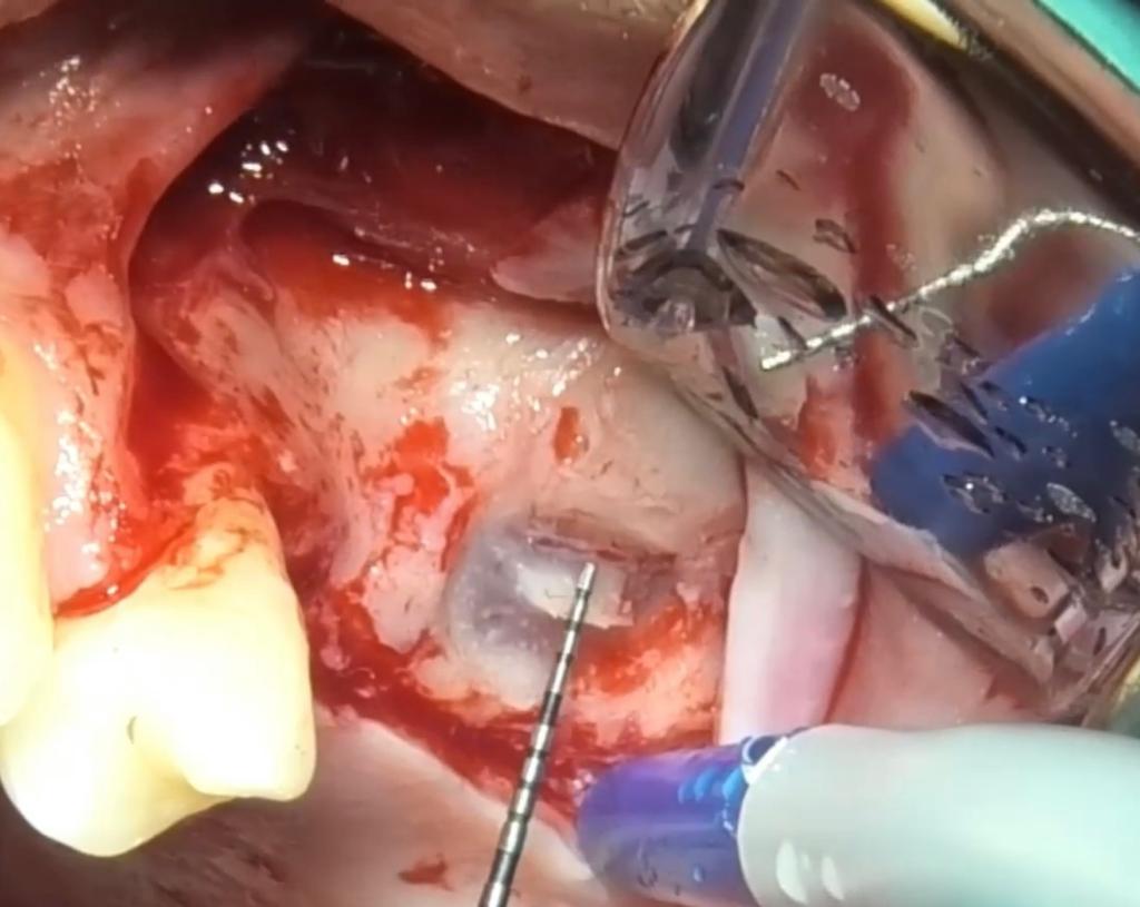 CLINICAL VIDEO Sinus Lift Bone Augmentation using a lateral window technique