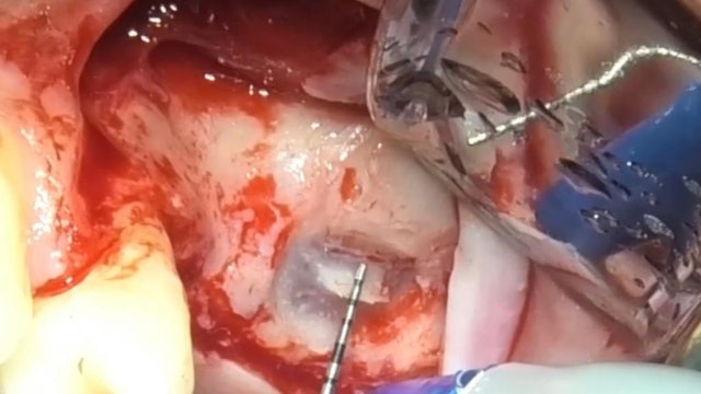 CLINICAL VIDEO Sinus Lift Bone Augmentation using a lateral window technique