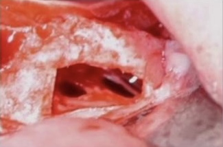 Complications during and after Sinus Bone graft and Augmentation