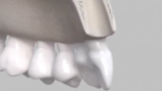 Implant placement in fresh extraction sockets: Key decision factors