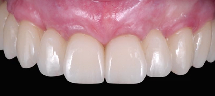 CLINICAL VIDEO Biological Potential of Hard and Soft Tissues | Jovanovic 