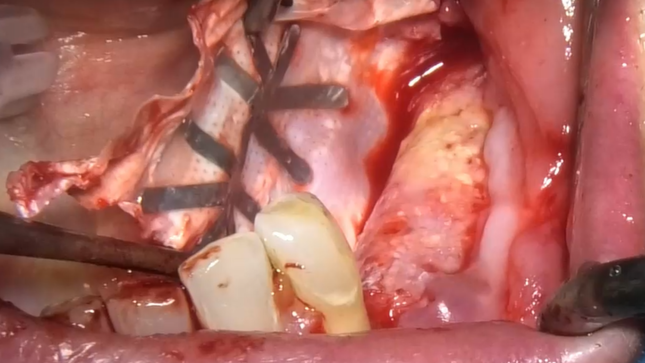 CLINICAL VIDEO Vertical Ridge Augmentation in the Posterior Mandible - Membrane 