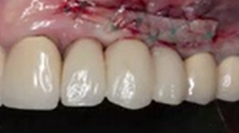 CLINICAL VIDEO  Free Gingival Harvest and Uncovering of Two Anterior Implants