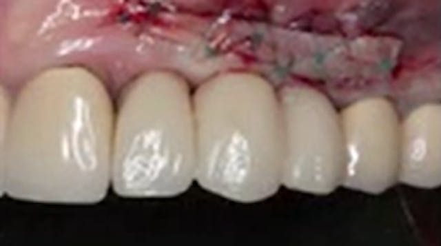 CLINICAL VIDEO  Free Gingival Harvest...