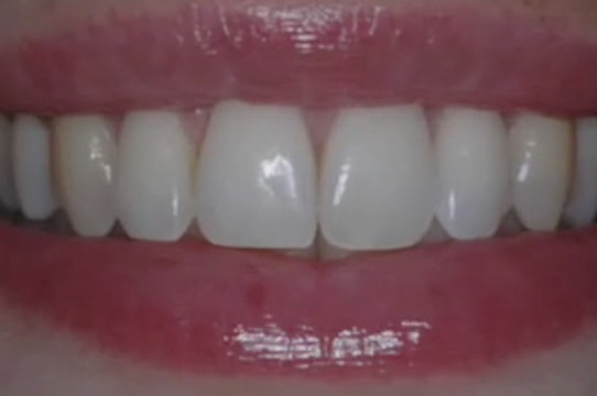 Treatment of Gingival Recession - Part 2 of Achieving Esthetic Predictability i