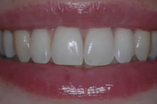 Treatment of Gingival Recession - Par...