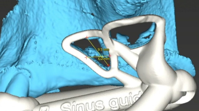 CLINICAL VIDEO Step-by-Step 3D Printed Sinus Window & Septum Surgical Guide