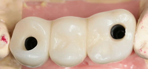 CLINICAL VIDEO Sinus Elevation and GBR (Part 2) - Implants Restored Zirconia Imp