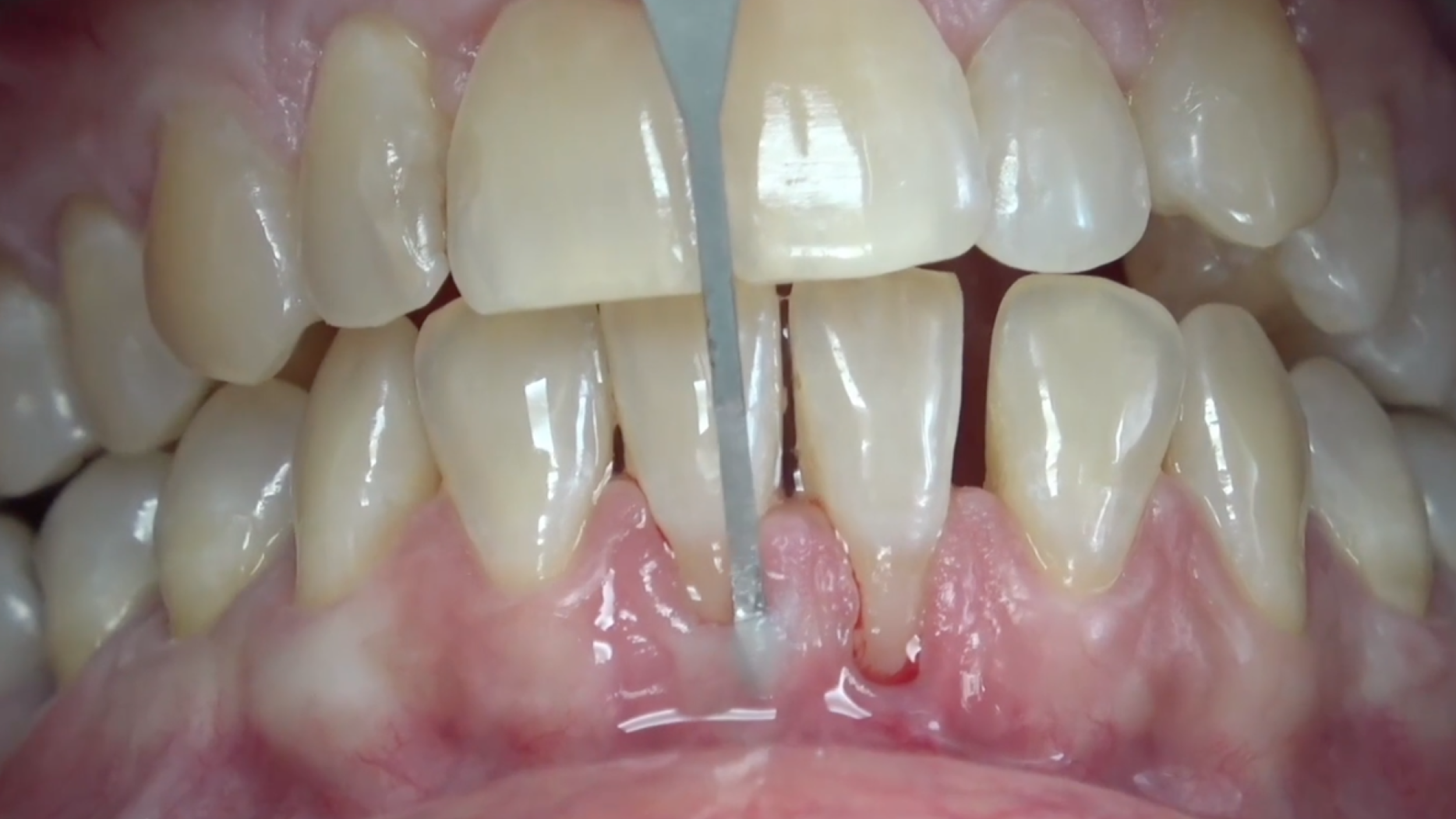 CLINICAL VIDEO Tunneling Technique for Dual Lower Gingival Root Recessions