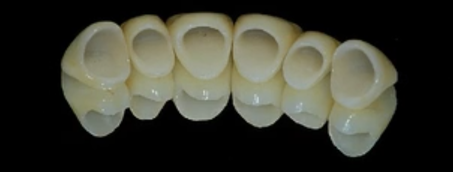 All-Ceramic Solutions On Teeth & Implants