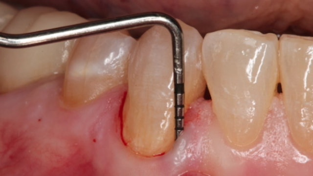CLINICAL VIDEO Delayed extraction site Treatment with a TLX Implant & simultaneo