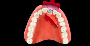 Soft Tissue Grafting for Implant Complications in the Esthetic Zone