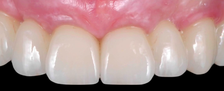 Evidence and Clinically Based Protocols in Implant Dentistry Part 01
