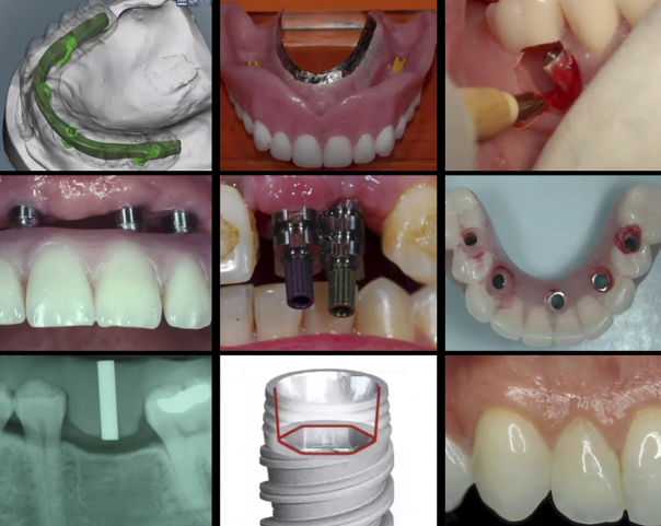 [PLAYLIST] A-Z in Restorative Implant Dentistry