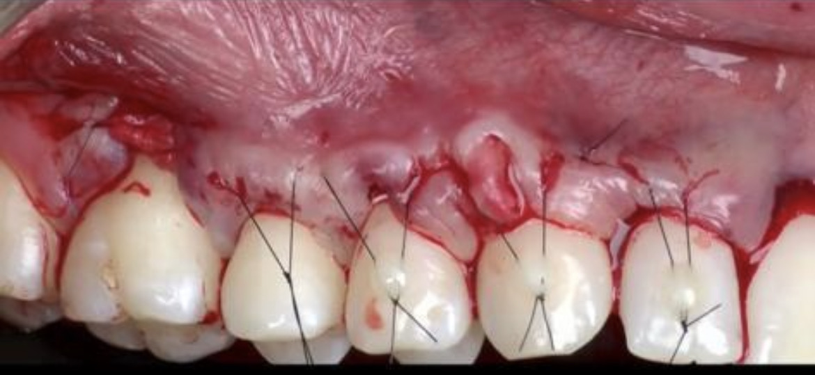 CLINICAL VIDEO Tunneling Procedure & Connective Tissue Grafting | Mintrone