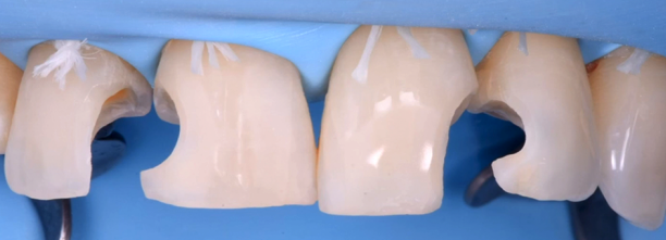 [PLAYLIST] Direct and Indirect Adhesive Restorations