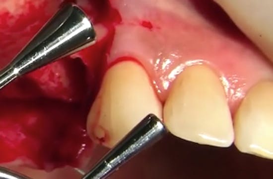 CLINICAL VIDEO Sinus Elevation and GB...