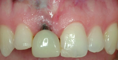 Soft Tissue Management and Esthetic Failure Around Osteointegrated Implants