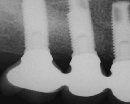 CLINICAL VIDEO Sinus lift bone graft ...