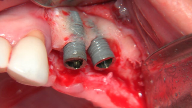 CLINICAL VIDEO Periimplantitis Treatment for Two Long-Term Functioning Upper Imp