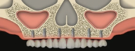 The Trajectory of Zygomatic Implants in the Restoration of the Severely Atrophi
