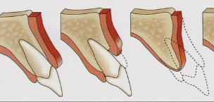 Esthetic Fine Tuning in Complex Implant Cases