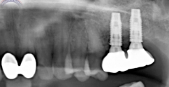 Classification for Minimally Invasive Sinus Bone Grafting (Part 2 of 2)