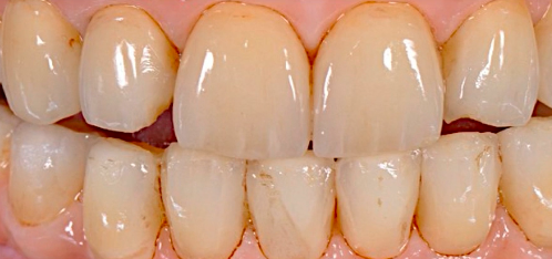 A Novel Approach to Implant Screw-Retained Restorations | Dr Giacomo Fabbri