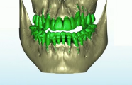 Surgically Facilitated Orthodontic Therapy