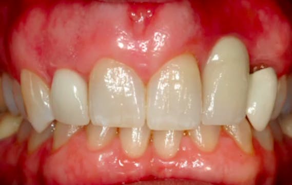 A-Z in Restorative Implant Dentistry ...