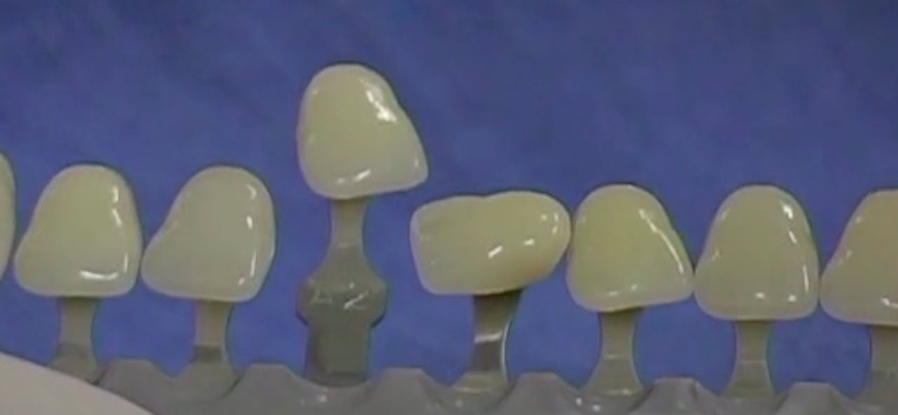 CLINICAL VIDEO Final implant restorative treatment using Procera crown