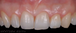 Prosthetic Rehabilitation on Natural Teeth