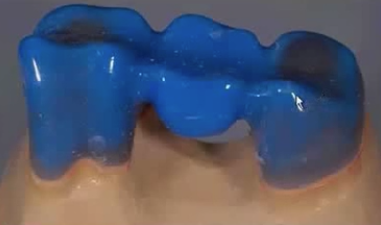 Zirconia Based Restorations for Esthetic Results and Longevity