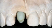 Aesthetic Results Using The Scalloped Implant Design