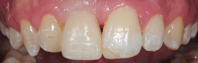 CLINICAL VIDEO Anterior Implant Placement with Simultaneous GBR -  Jovanovic