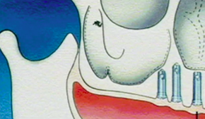 A systematic surgical and restorative plan for treatment of the Edentulous Pati