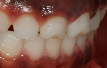 Bio-Esthetics with Freehand Bonding 2.0