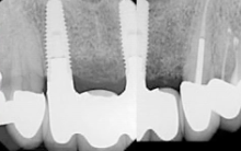CLINICAL VIDEO Simultaneous Extraction, Implant Placement and Ridge Augmentation