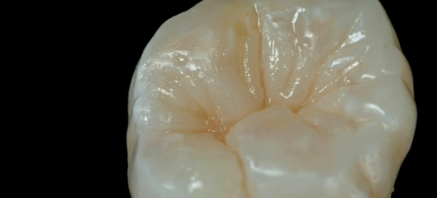 A Simplified Layering Method for Direct Posterior Restoration
