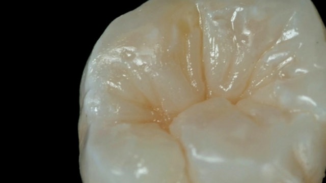 A Simplified Layering Method for Direct Posterior Restoration
