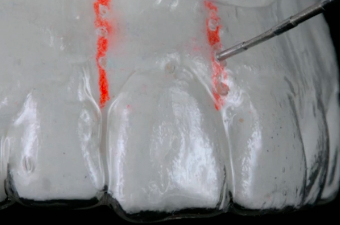 CLINICAL VIDEO Tooth Replacement with a Preplanned Custom Abutment  |Dr Mintrone