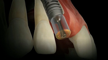 Paradigm Shift – Soft Tissue Concept | Dr Iñaki Gamborena
