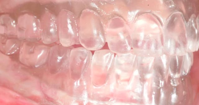 Complete Zirconia Restorations – Impl...