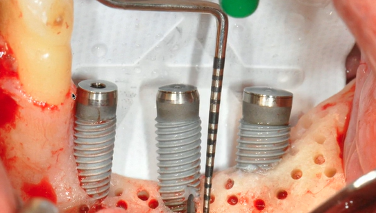 Surgical Approach | Dr Marco Ronda