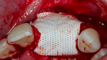 [PLAYLIST] Guided Bone Regeneration