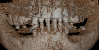 CLINICAL VIDEO Sinus Elevation with a Lateral Approach
