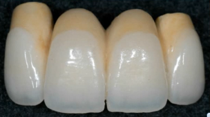 Horizontal Bone augmentation using bone grafts and non-resorbable membranes