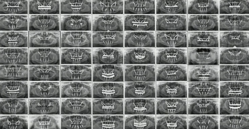 The Trajectory of Zygomatic Implants in the Restoration of the Severely Atrophi